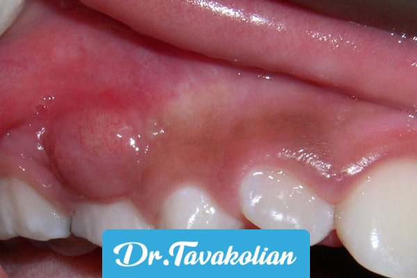 علت و درمان آبسه دندان کودکان