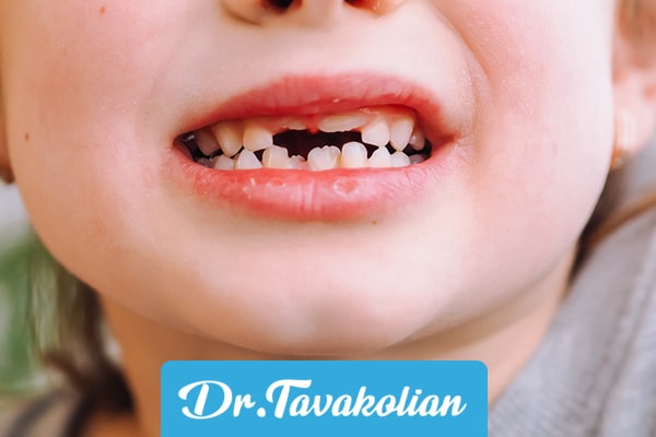 ترتیب افتادن دندان شیری