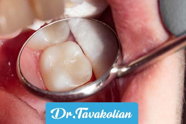 فیشور سیلانت یا شیار پوش دندان کودکان