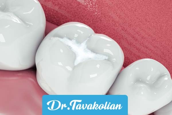 فیشور سیلانت یا شیار پوش دندان کودکان