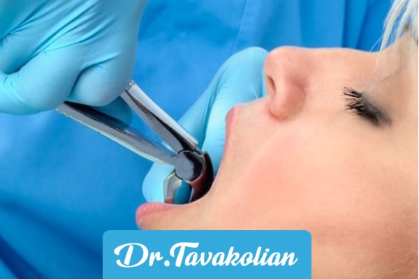 نحوه کشیدن دندان های کودکان