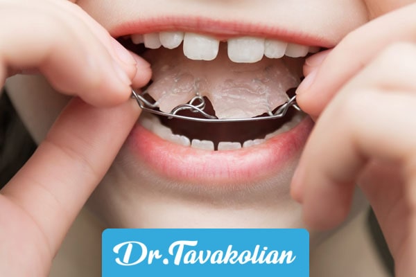 ارتودنسی درمان دندان قروچه کودکان