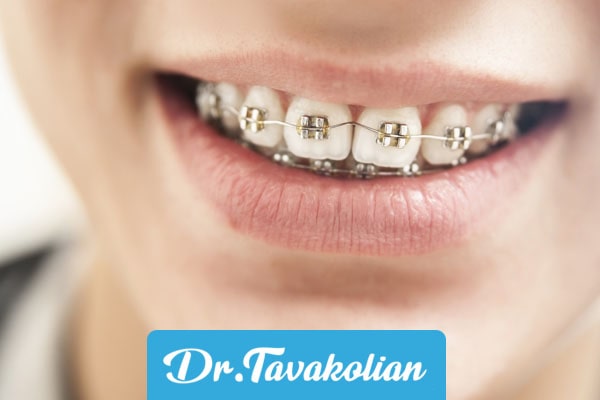 ارتودنسی درمان دندان قروچه کودکان