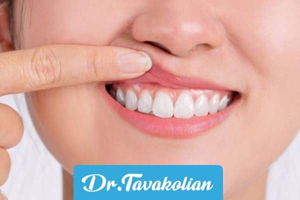 درمان خانگی آبسه دندان کودکان