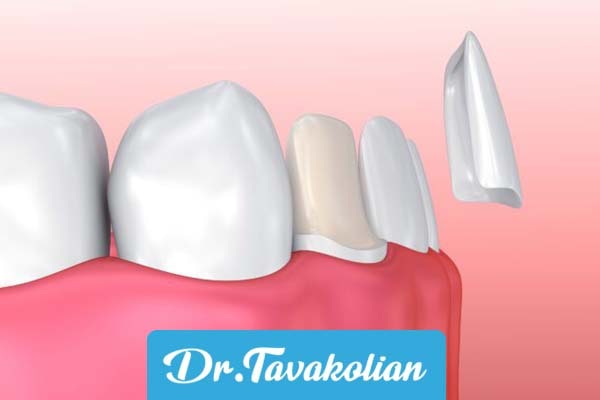 معرفی انواع روکش دندان کودکان