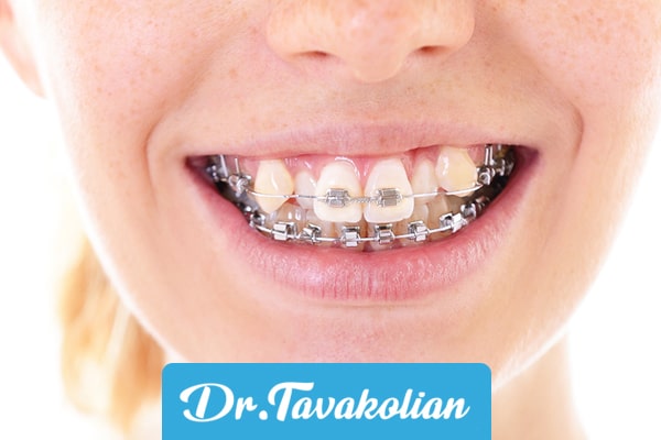 علت های اصلی کج شدن دندان‌ها در کودکان