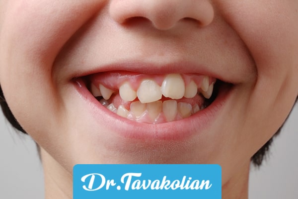 عکس دندان کج کودکان