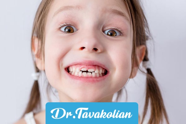 علت های اصلی کج شدن دندان‌ها در کودکان
