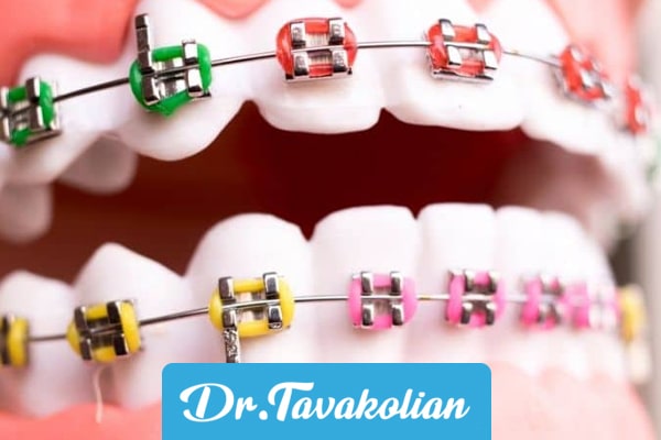 ارتودنسی رنگی دندان کودکان