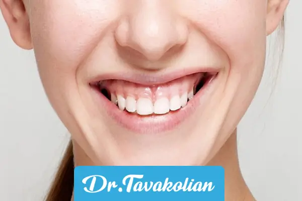 لبخند لثه ای بزرگسالان