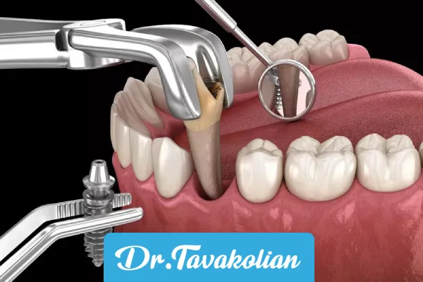 ایمپلنت دندان بعد از کشیدن