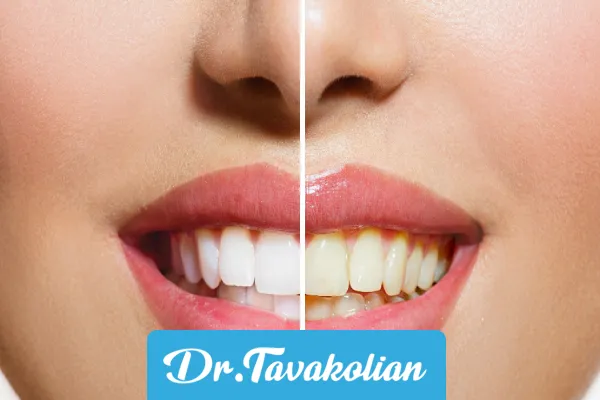 جرمگیری دندان