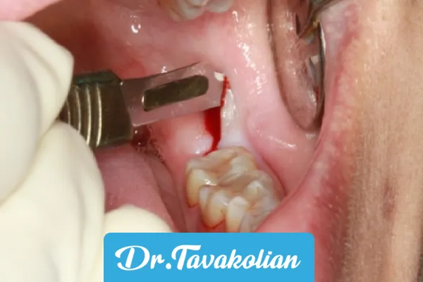 جراحی دندان عقل