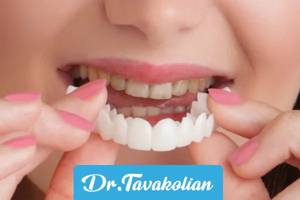 لمینت متحرک