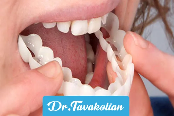 نمونه ای از لمینت متحرک 