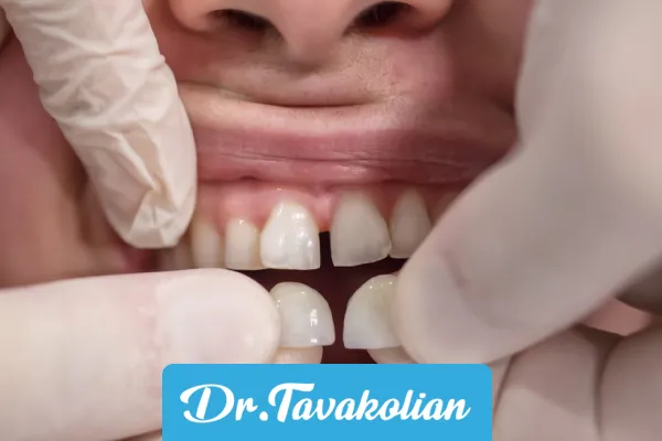 کامپوزیت دندان کج