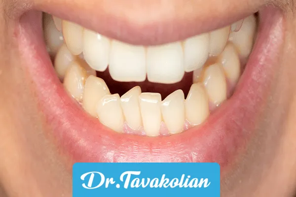 مراحل کامپوزیت دندان کج