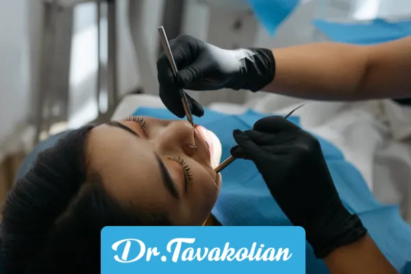 لمینت بدون تراش