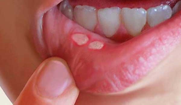 نحوه گاز گرفتگی 