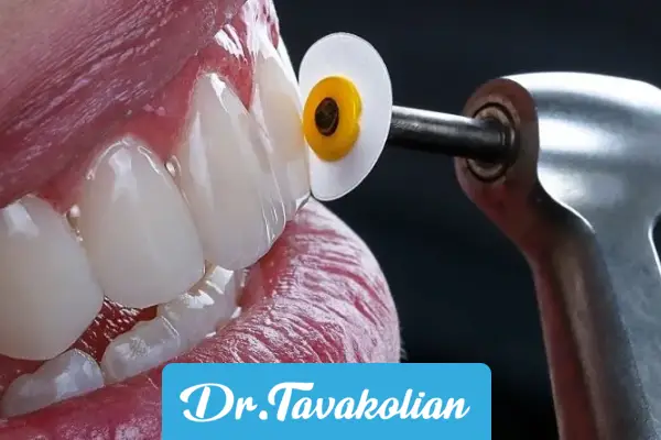 کامپوزیت دندان را میتراشند؟