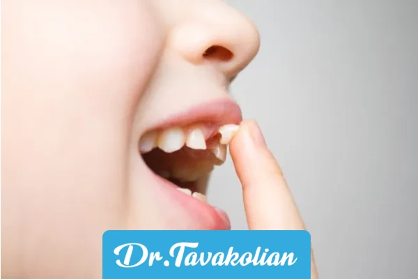 دیر افتادن دندان شیری