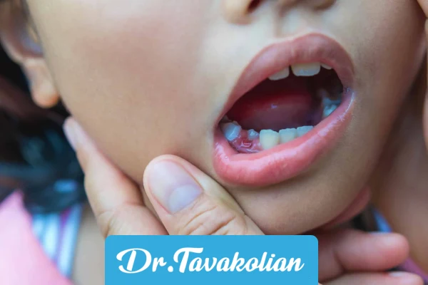 دیر افتادن دندان شیری