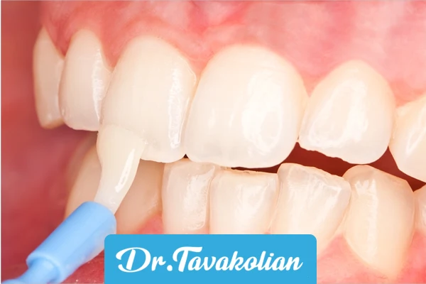 وارنیش فلوراید