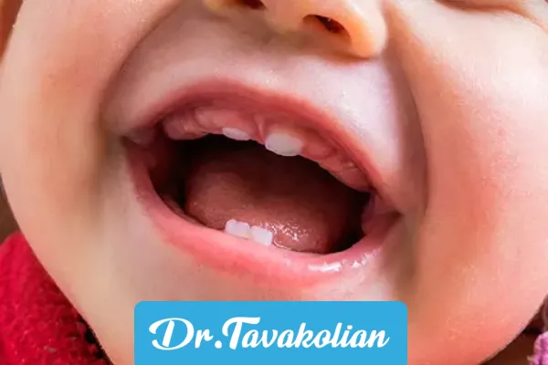 عکس لثه نوزاد هنگام دندان دراوردن