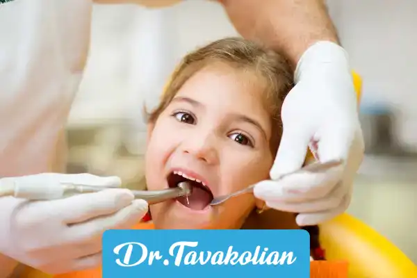 روکش دندان های شیری یا SSC