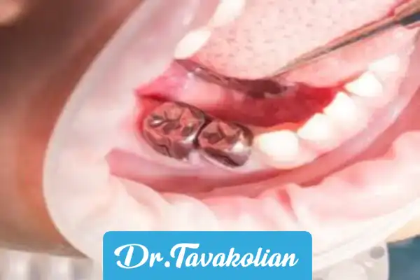 انواع روکش‌های دندانی مخصوص کودکان