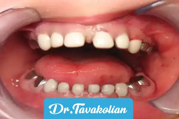 فرایند نصب روکش دندان شیری