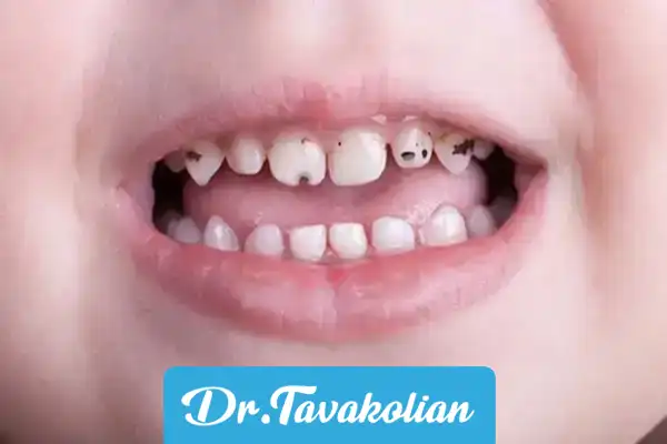 راه‌ های پیشگیری از پوسیدگی دندان