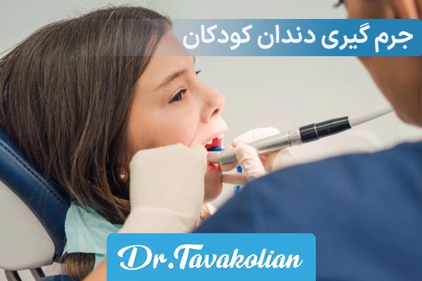 جرم گیری دندان کودکان