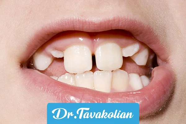 رشد دندان‌های دائمی کودکان