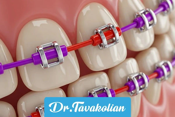 براکت‌های رنگی دندان کودکان