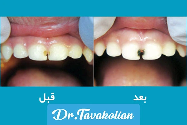 مزایای سیلورتراپی