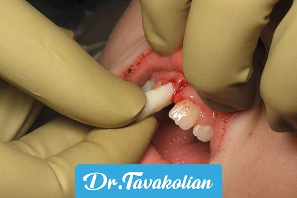 ترومای دندان شیری