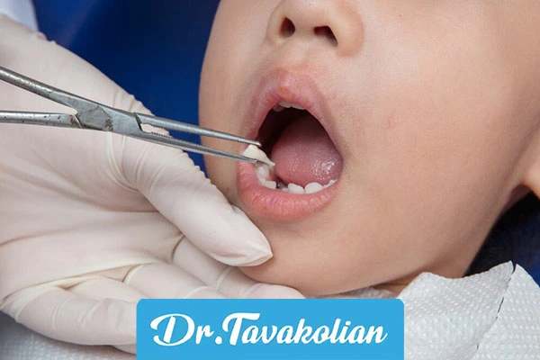 دندان شیری شکسته