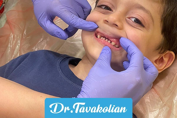 دندان کودک افتاده