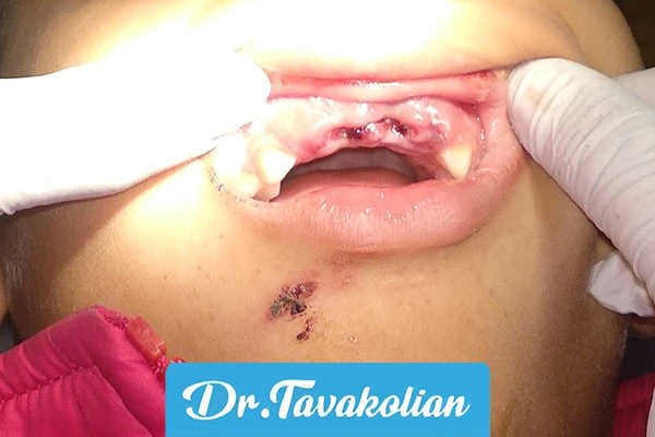 ضربه به دندان شیری