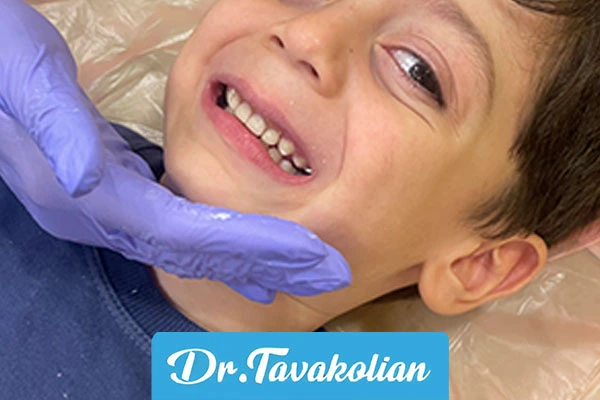 پوسیدگی زودرس دوران کودکی (ECC)