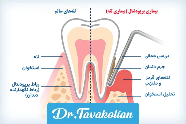 التهاب لثه در نوجوانان