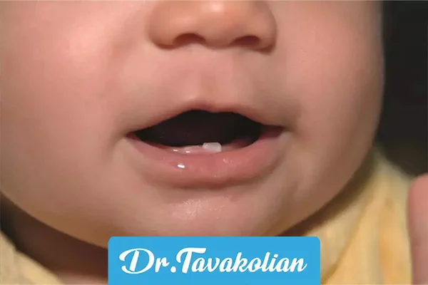 تنفس دهانی در کودکان