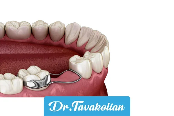 نگهدارنده فضا (اسپیس منتینر)